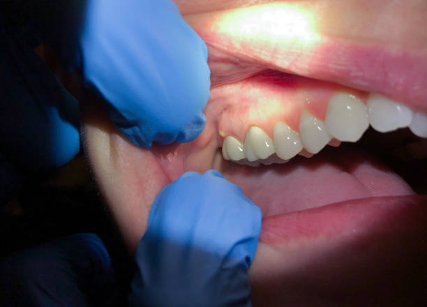 Teeth Whitening in CO